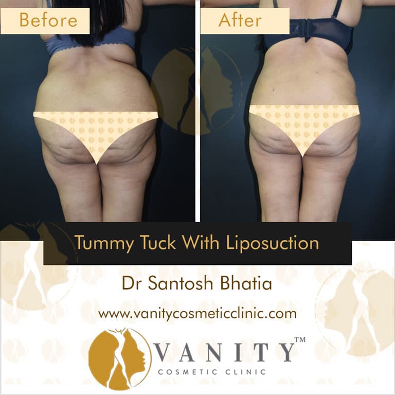 tummy-tuck-with-liposuction-back-view-2