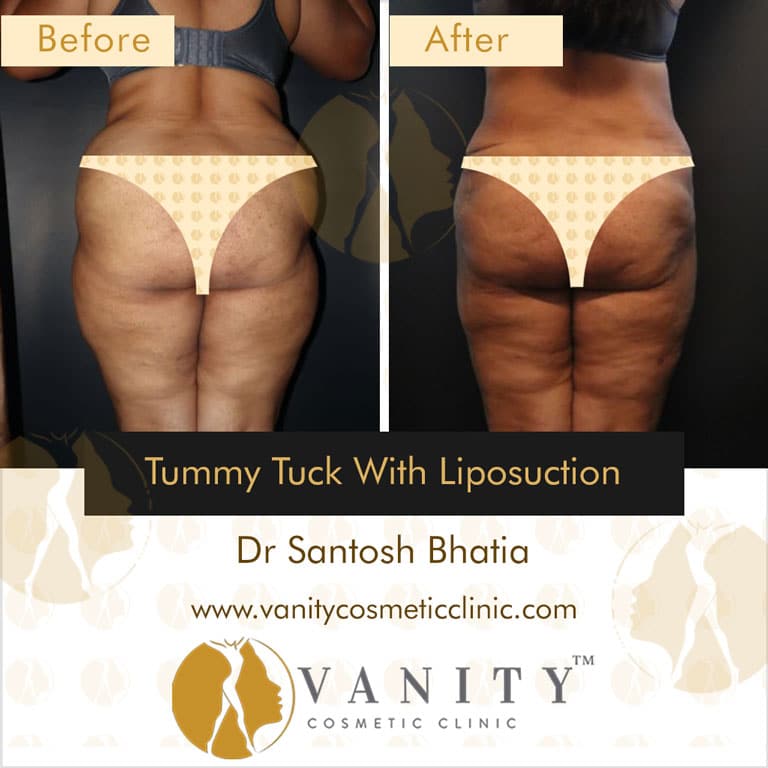 tummy-tuck-with-liposuction-back-view