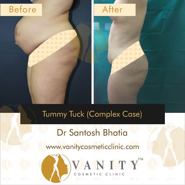 What Are the Side Effects of Tummy Tuck Surgery?