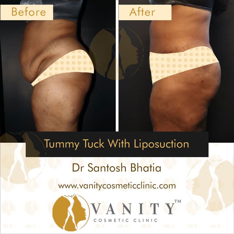 tummy-tuck-with-liposuction-left-side-view-1_1