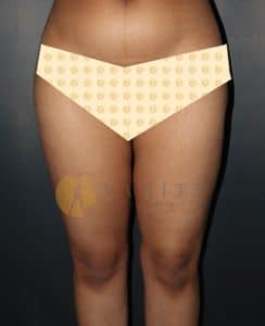liposuction-thighs-front-view-after