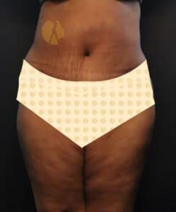 tummy-tuck-with-liposuction-front-view-after