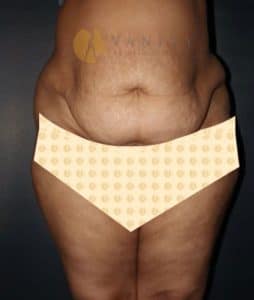 tummy-tuck-with-liposuction-front-view-before