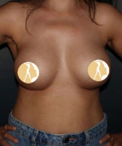 Breast-Augmentation-After