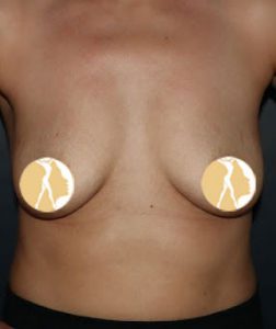Breast-Augmentation-Before