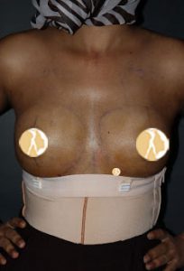 Breast Augmentation with fat Injection Stage-1-After