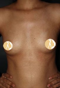 Breast Augmentation with fat Injection Stage-1-Before