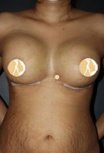 Composite Breast Augmentation (Implant+Fat Injection) After