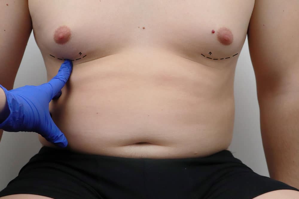 Gynecomastia