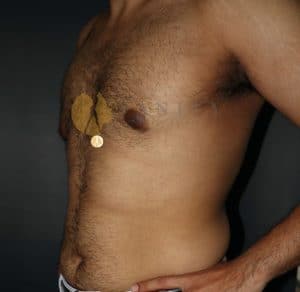 Gynecomastia-45-deg-view-after