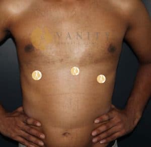 Gynecomastia-front-view-after-1