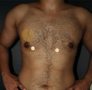 Gynecomastia-front-view-after