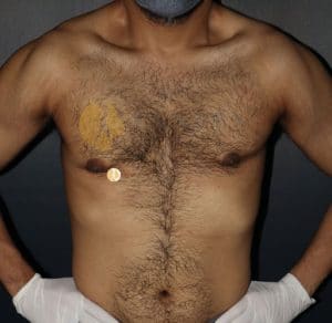 Gynecomastia-front-view-before-3