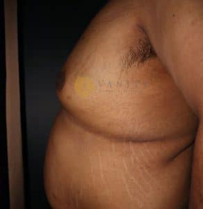 Gynecomastia-side-view-before-3