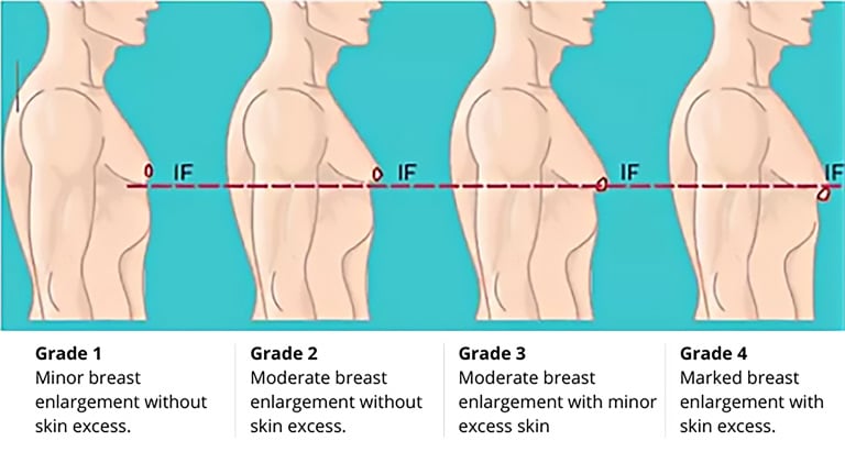 classification-of-gynecomastia-6