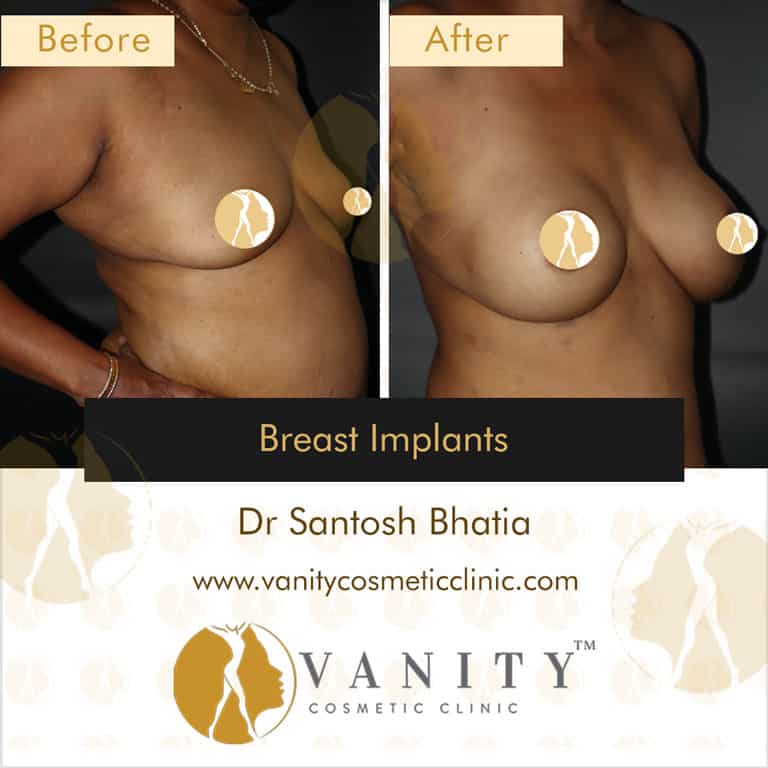 Before & After Pictures of Clients - Vanity Cosmetic Clinic