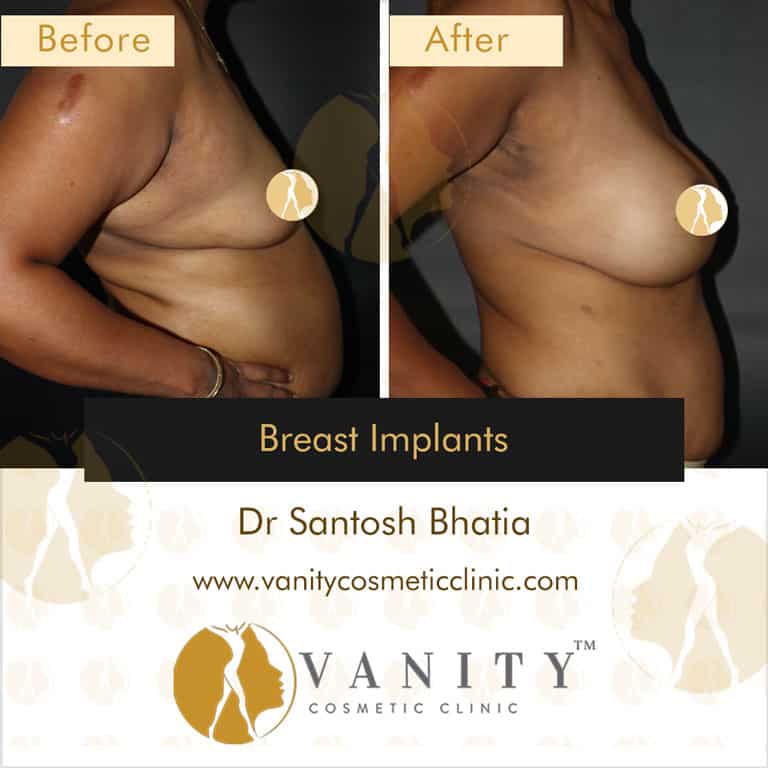 Natural Breast Augmentation & Enhancement with Fat Transfer - Miami Breast  Center in 2024