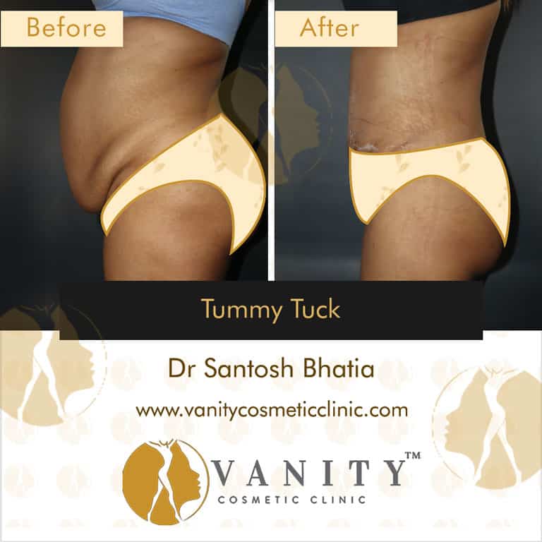 mommy-makeover-tummy-tuck-vanity-cosmetic-clinic-left-side-view-5