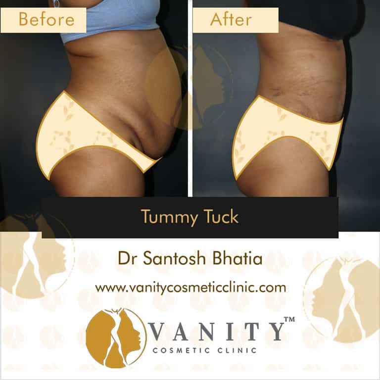 mommy-makeover-tummy-tuck-vanity-cosmetic-clinic-right-side-view-5