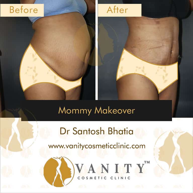 mommy-makeover-vanity-cosmetic-clinic-45-deg-right-side-view-5