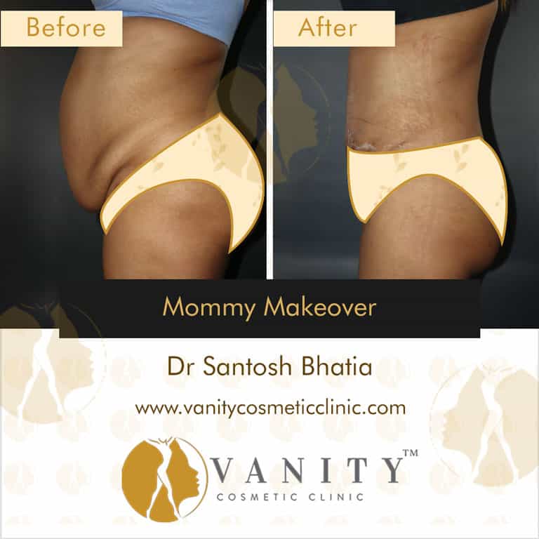 mommy-makeover-vanity-cosmetic-clinic-left-side-view-5