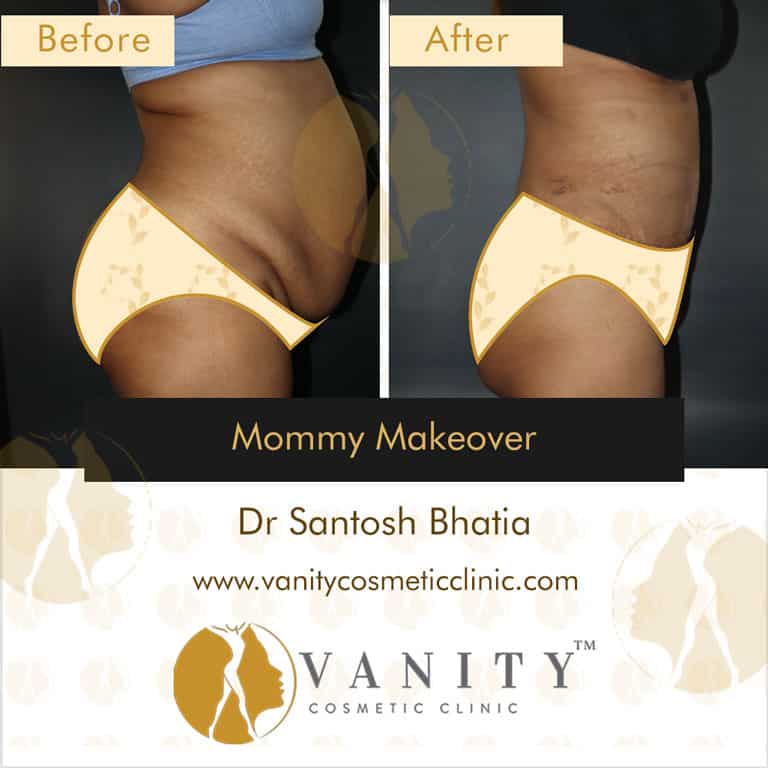 mommy-makeover-vanity-cosmetic-clinic-right-side-view-5