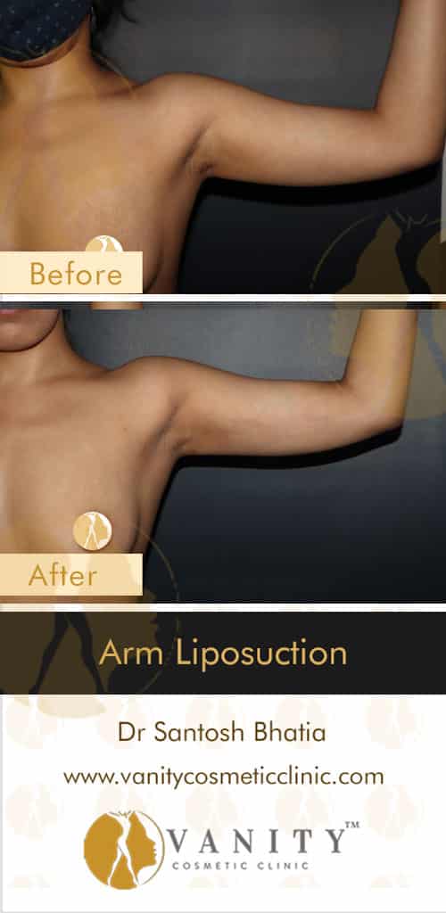 vcc-before-after-arm-liposuction-front-left-view