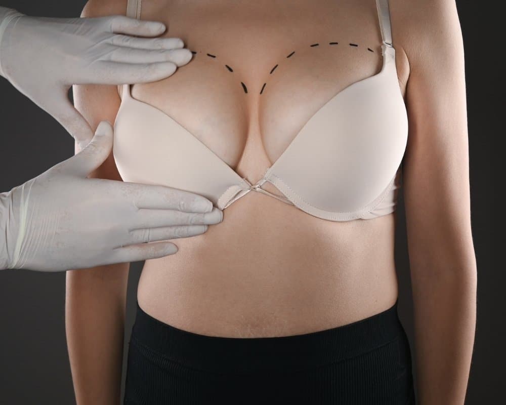 Sagging breasts? Do you need breast implants or an uplift?