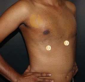 Gynecomastia-front-view-after-2