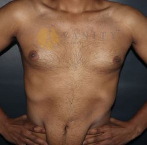 Gynecomastia-front-view-before